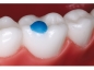 Preview: Reliamold™, Łuk na zęby trzonowe