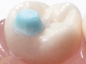 Preview: MiniMold System, Łuk na zęby trzonowe