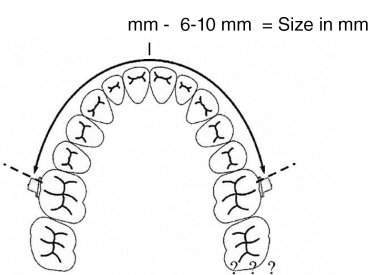 Łuk dystalizujący zęba trzonowego, rozmiar 6 (95 mm)