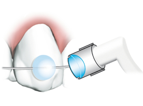 MiniMold System, Łuk na zęby trzonowe